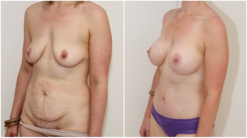 Mummy Makeover with breast augmentation using 420g gel implants, muscle tightening full tummy tuck.
