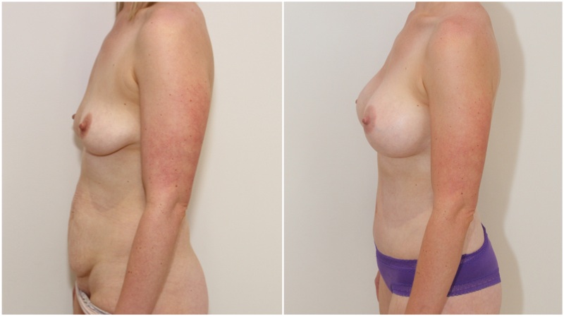 Mummy Makeover with breast augmentation using 420g gel implants, muscle tightening full tummy tuck.