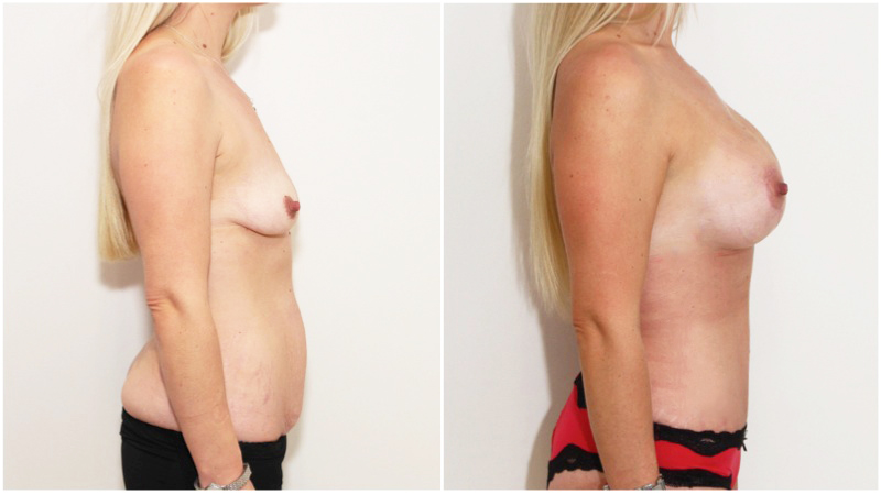Mummy Makeover including breast lift/reshape + 325cc implants as well as muscle tightening tummy tuck to create a waistline.