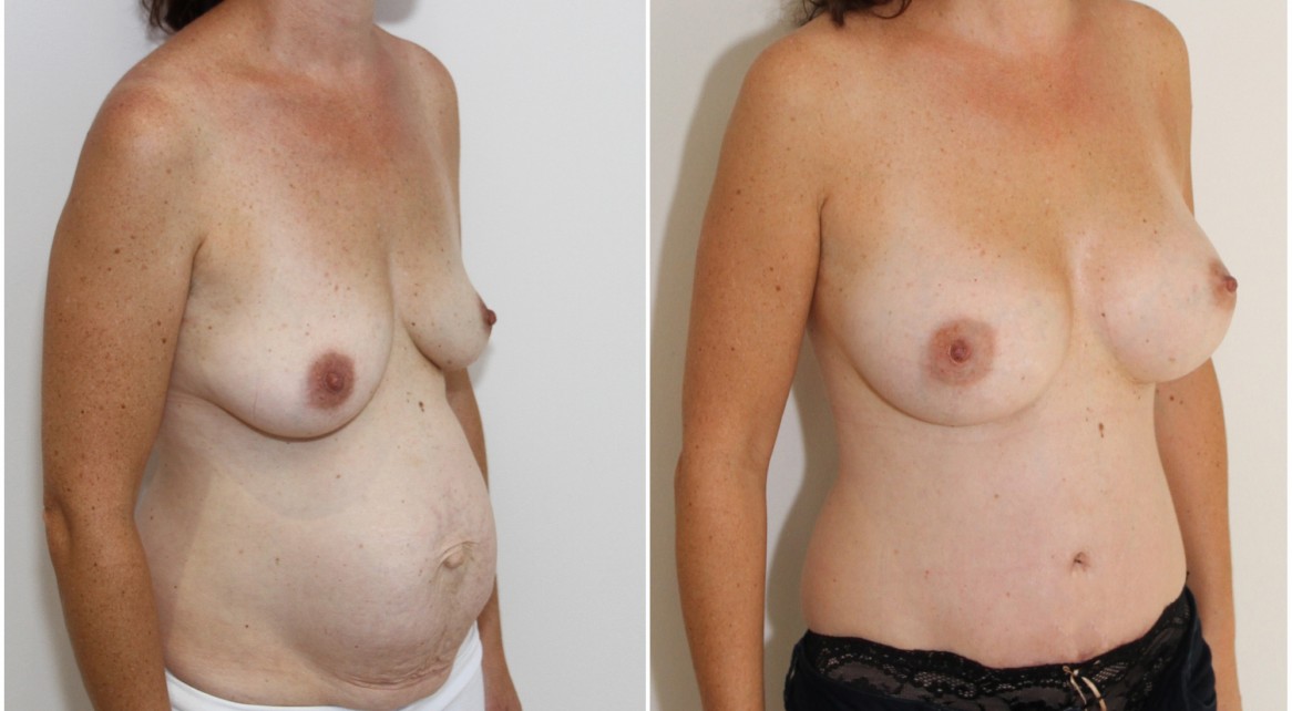 Mummy Makeover including breast augmentation with 375g memory gel anatomical implants and a waist defining, muscle tightening tummy tuck.