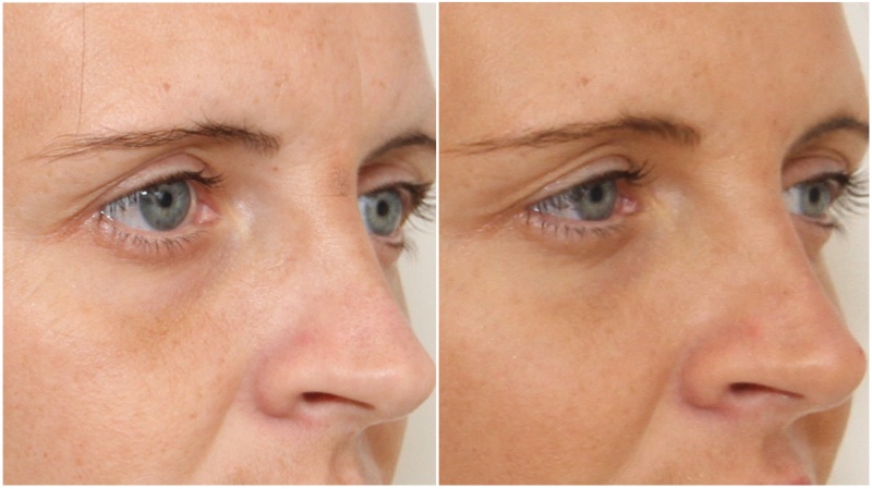 Hydrating filler used to soften under eye hollows