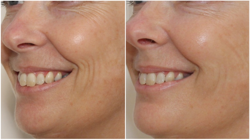 Decreasing accordion lines (smile lines) with hydrating dermal fillers