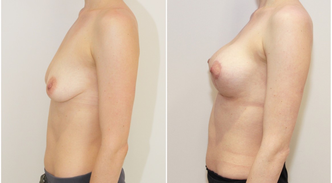 Breast lift/reshape + implants with 275g round style implants.