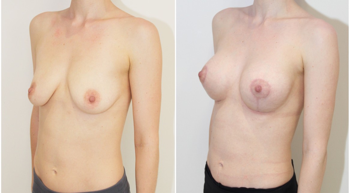 Breast lift/reshape + implants with 275g round style implants.