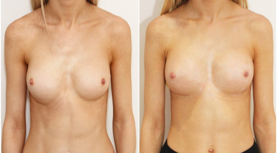 Bottoming out right breast implant corrected with bilateral removal and replacement of implants / internal bras and capsular flaps.