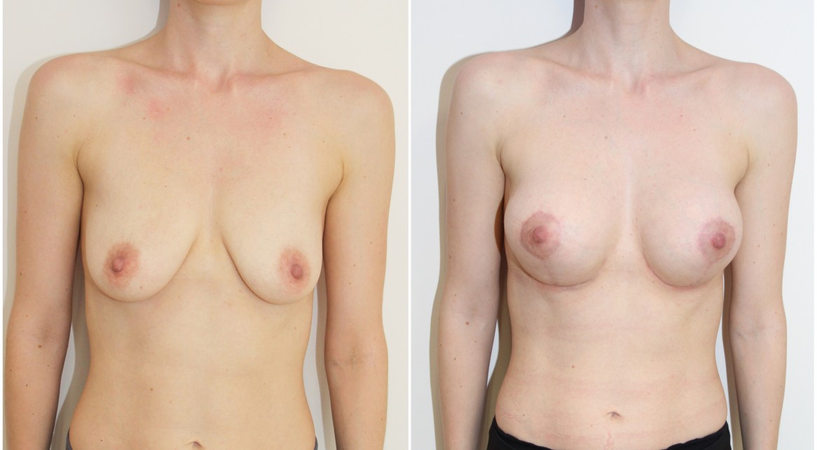 Breast lift/reshape + implants with 275g round style implants.