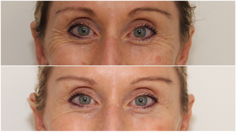 Wrinkle relaxing injections used to soften crows-feet and lift the brow