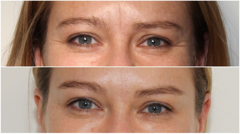 Anti-wrinkle injections used to soften frown lines and crows-feet and lift the brow