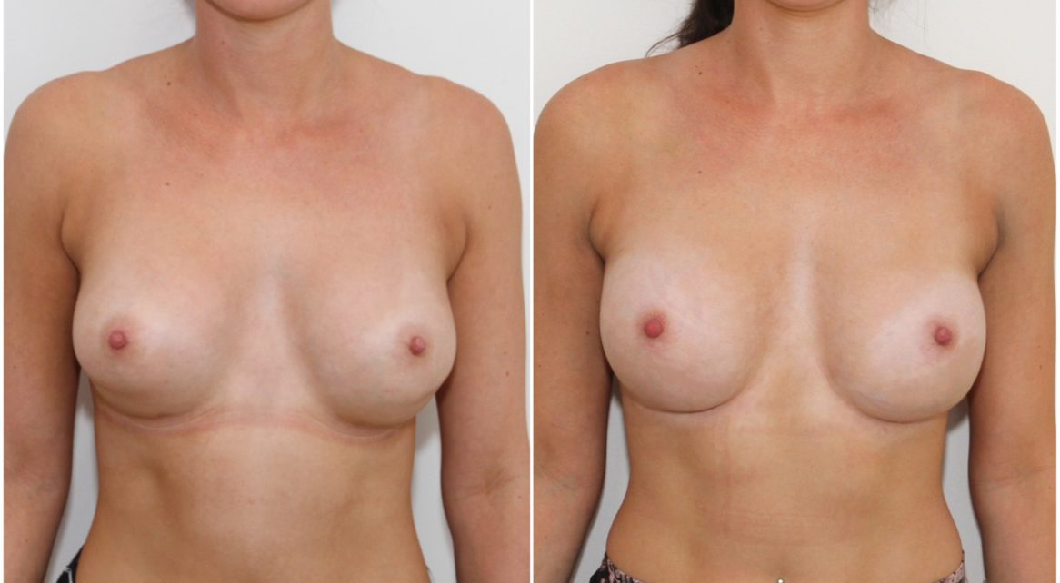 Correction of double bubble deformity with plane change and internal bra.