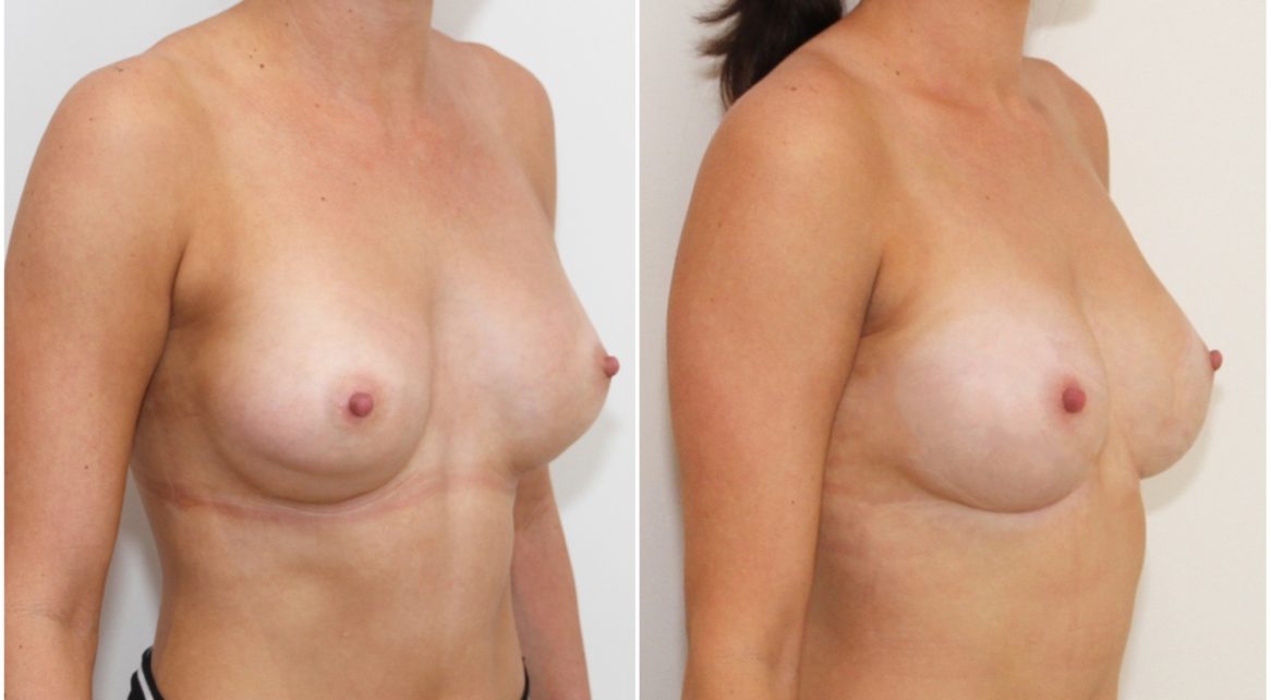 Correction of double bubble deformity with plane change and internal bra.
