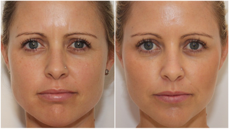 Facial slimming and jaw definition achieved by using anti-wrinkle injections