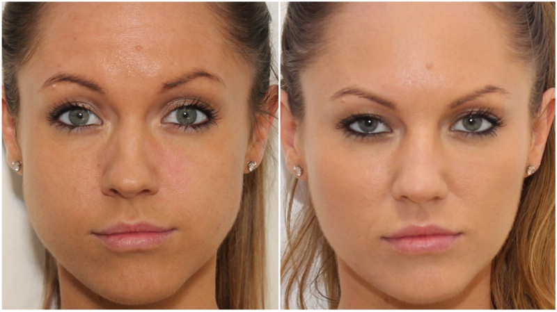 Facial Slimming and jaw definition achieved using anti-wrinkle injections