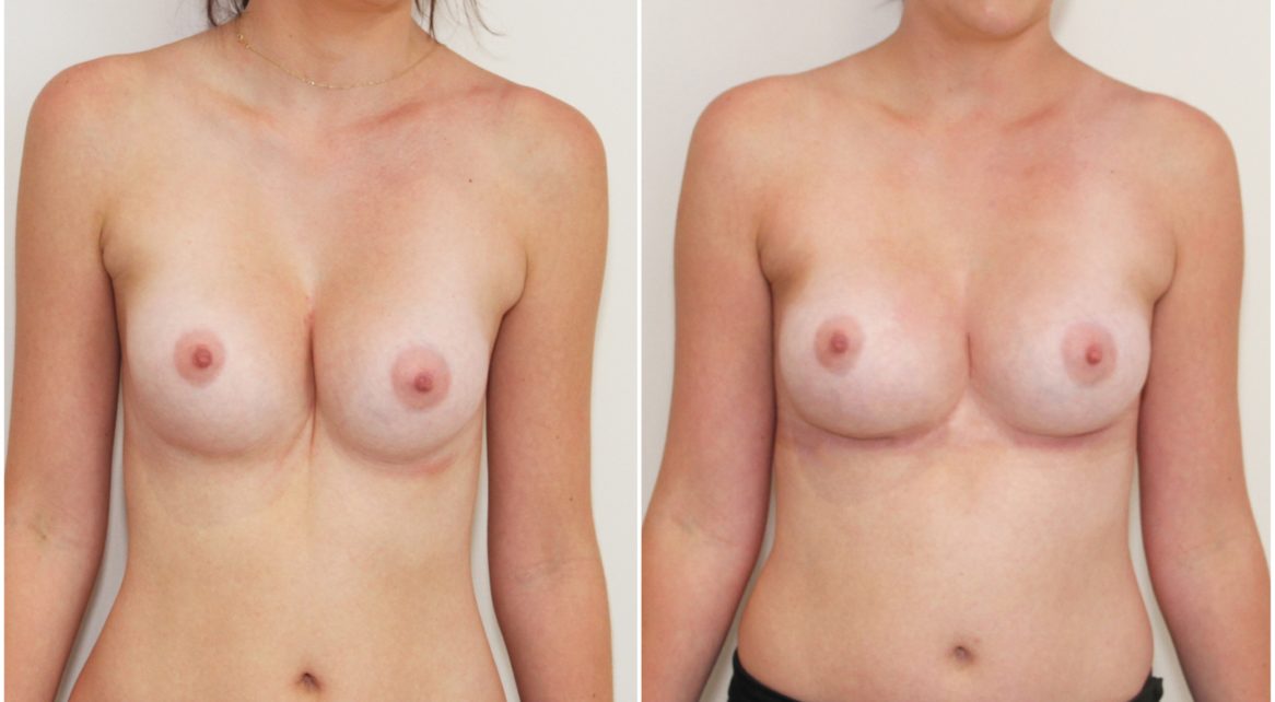 Coorection of asymmetry, severe funnel chest and implant malposition with implant removal, exchange, fat grafting and bilateral internal bras.