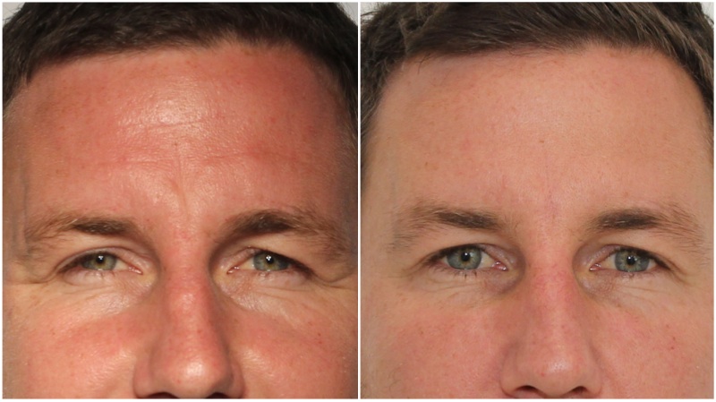 Frown and forehead lines softened using anti-wrinkle injections