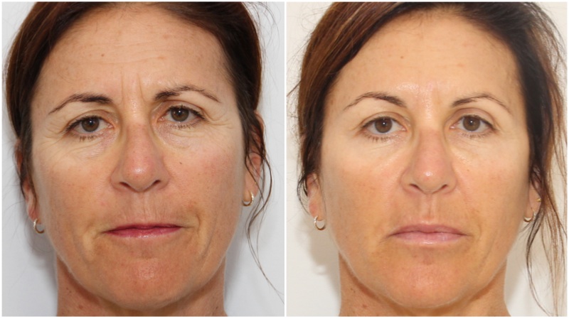 Volumising filler to the replace lost cheek projection, hydrating filler used to soften lip lines (smokers lines), under eye hollows, and enhance lip volume. Forehead, frown lines , smokers lines and crows feet treated with anti-wrinkle injections