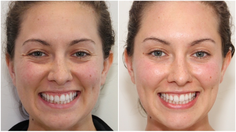 Crows-feet, frown and forehead lines softened using anti-wrinkle injections
