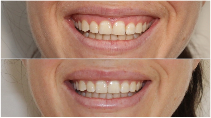 Softening a gummy smile using anti-wrinkle injections