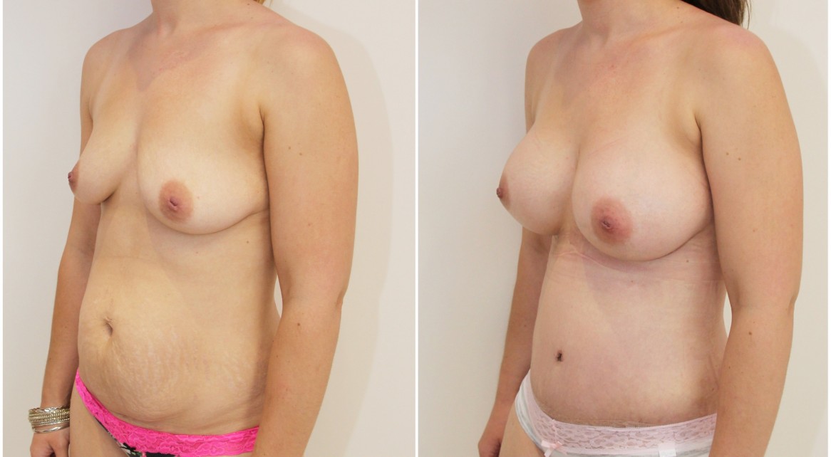 Mummy makeover including breast augmentation with 415g full profile round implants and muscle tightening tummy tuck.