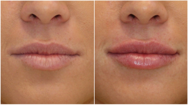 Lip volume enhanced using hydrating lip filler