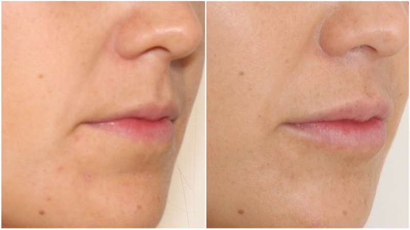 Hydrating lip filler treatment