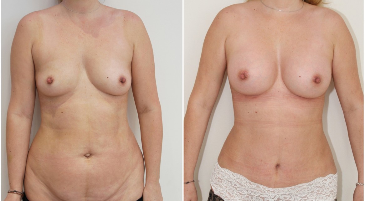 30s, mini mummy makeover with breast augmentation and mini-tummy tuck.