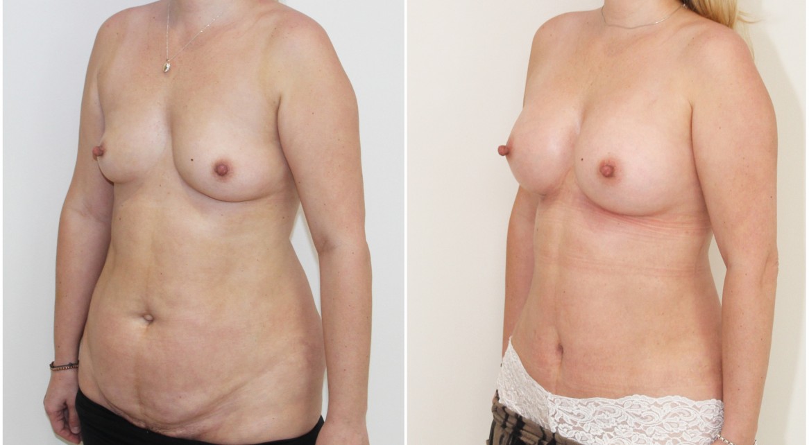 30s, mini mummy makeover with breast augmentation and mini-tummy tuck.