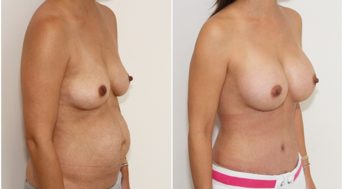 Mummy makeover with a breast augmentation using 300cc mod plus profile implants complemented with a waist tightening, abdominal contouring tummy tuck.