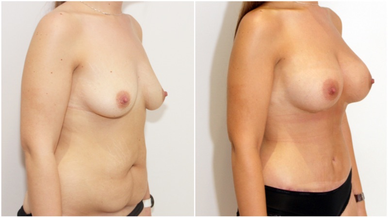 Breast augmentation combined with waist tightening tummy tuck (extended abdominolipoplasty)