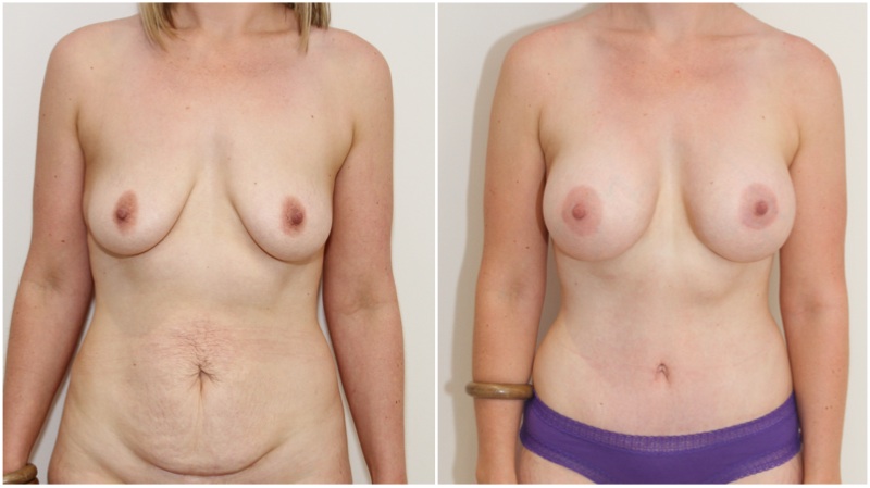 Mummy Makeover with breast augmentation using 420g gel implants, muscle tightening full tummy tuck.