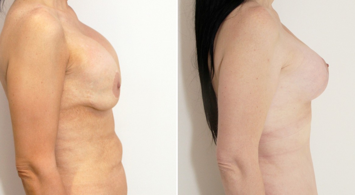 Correction of 'waterfall deformity' from previous breast augmentation surgery, with mastopexy/lift and implant exchange.