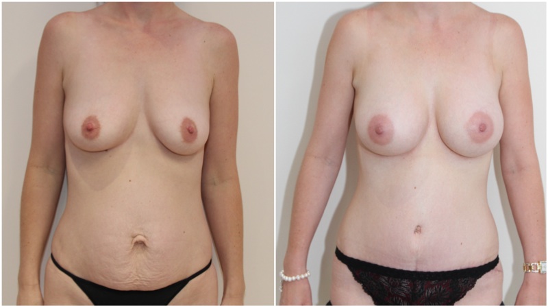 Mummy Makeover with full muscle-tightening, waist defining tummy tuck and breast enhancement.