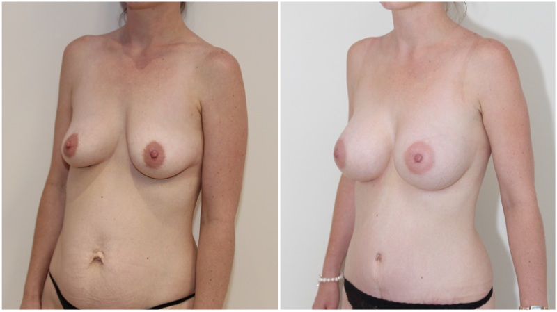 Mummy Makeover with full muscle-tightening, waist defining tummy tuck and breast enhancement.