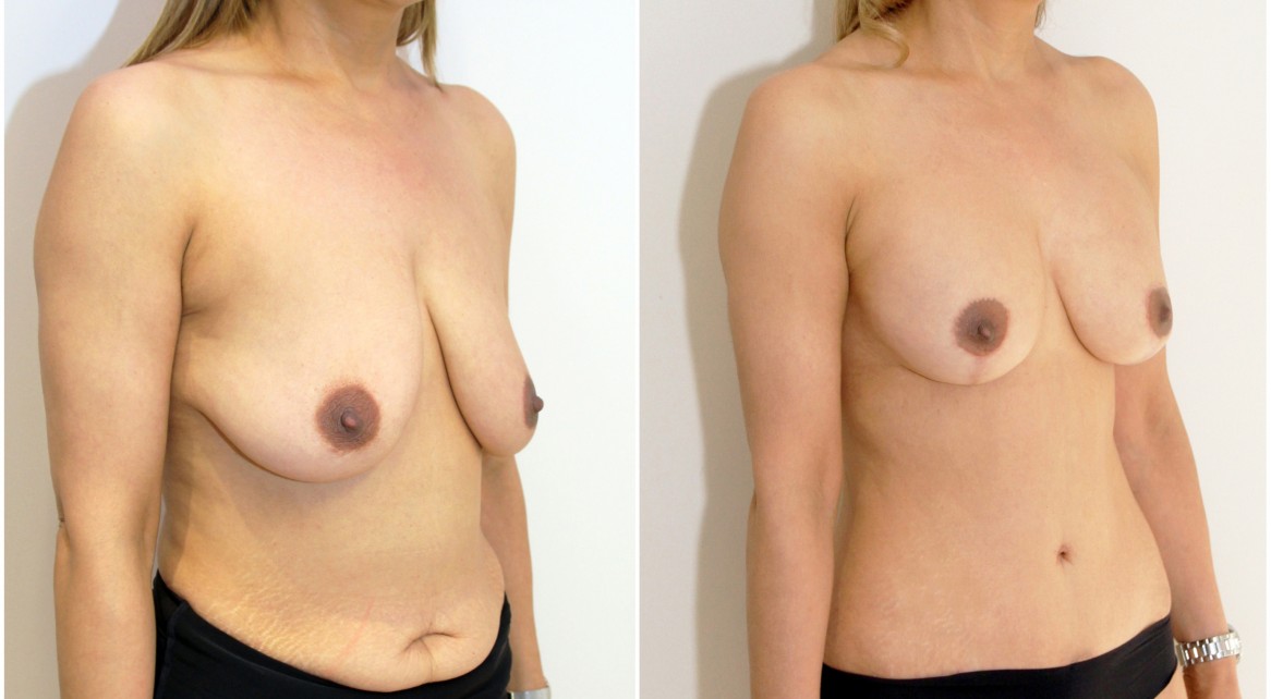 Mummy Makeover featuring a muscle tightening, waist creating full tummy tuck and breast lift.
