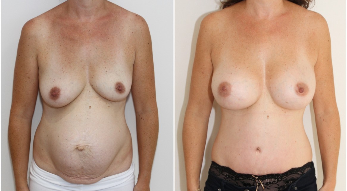 Mummy Makeover including breast augmentation with 375g memory gel anatomical implants and a waist defining, muscle tightening tummy tuck.