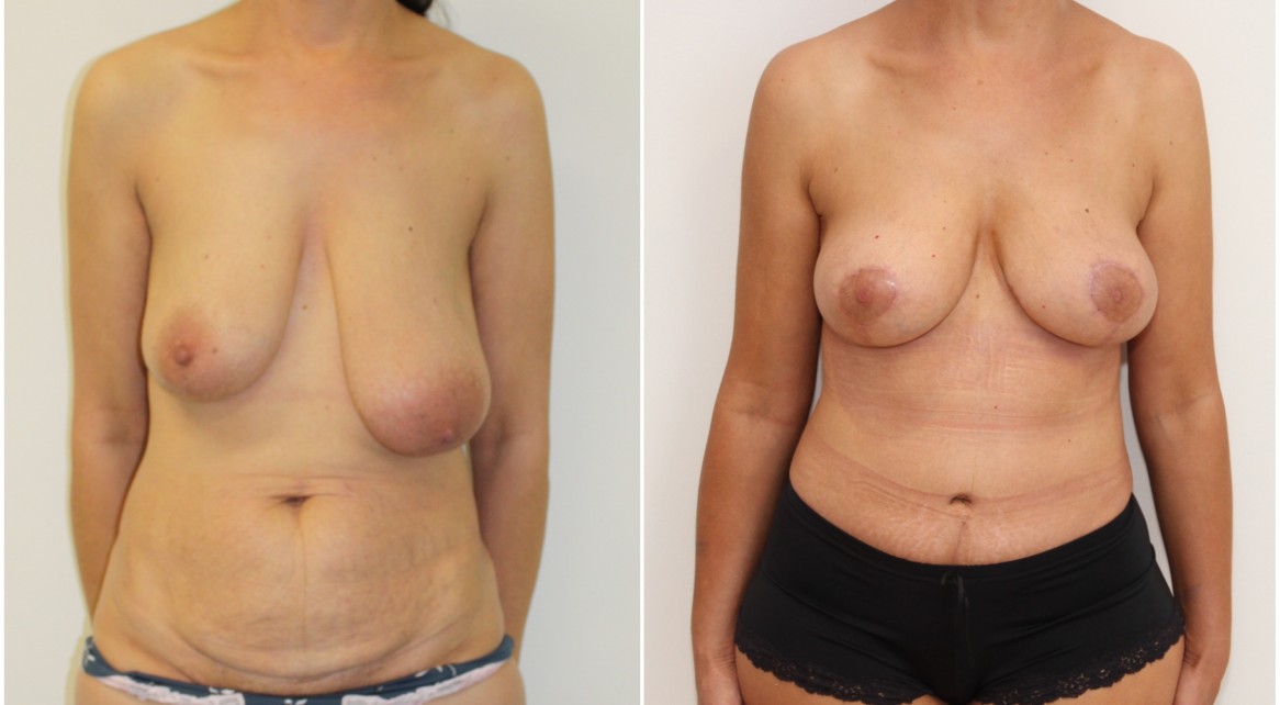 Breast lifting and reshaping procedure used to correct asymmetry without implants. Note a full tummy tuck has also been performed in this patient.