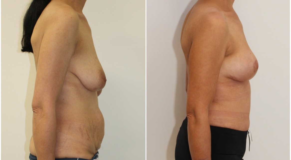 40s, mummy makeover including a breast lift/reshaping procedure without implants and full muscle tightening tummy tuck.