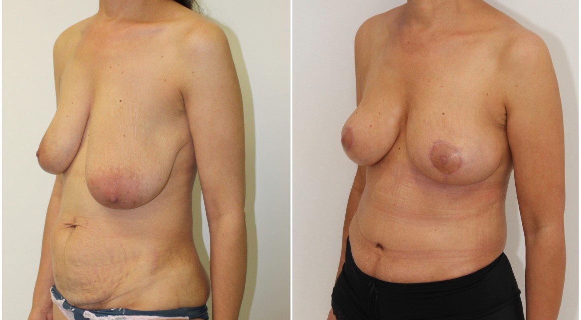 40s, mummy makeover including a breast lift/reshaping procedure without implants and full muscle tightening tummy tuck.