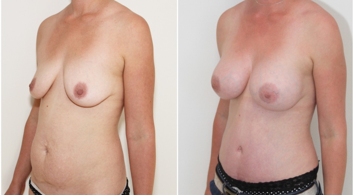 30s, mummy makeover with breast augmentation and full muscle tightening tummy tuck.