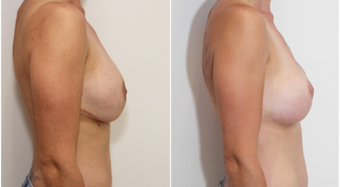 Previous breast surgery overseas, redo breast lift + implants to better tighten the skin envelope and shape the breast.
