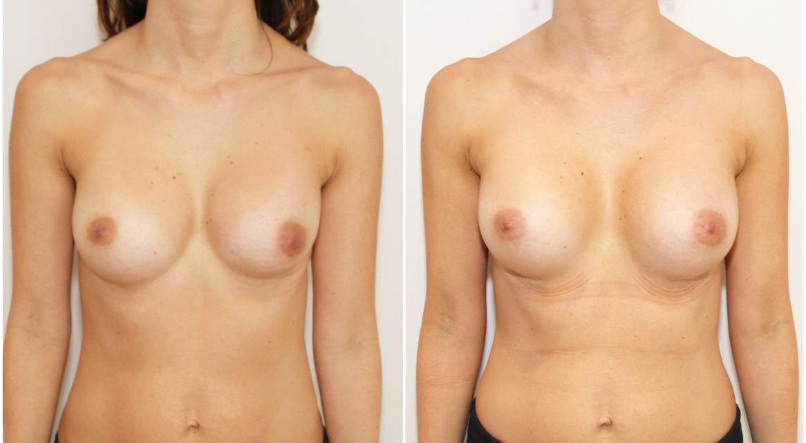 20s, breast augmentation revisional surgery removing existing malpositioned, contracted round implants and replacing with submuscular 470g P-URE style anatomics.