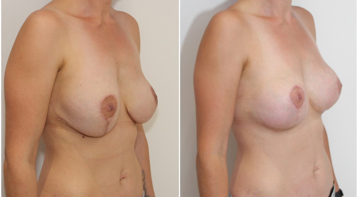 Previous breast surgery overseas, redo breast lift + implants to better tighten the skin envelope and shape the breast.
