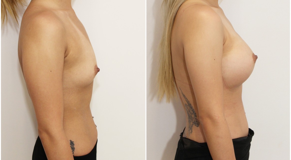 20s, breast augmentation with high profile, round style, dual plane positioned implants.