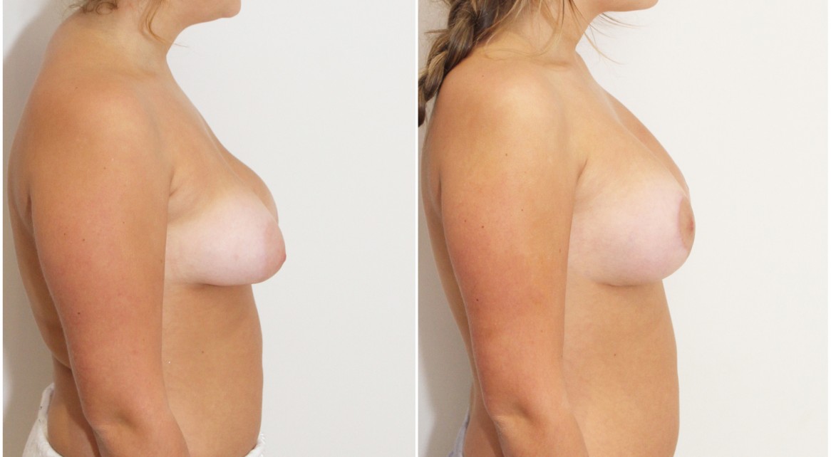 20s, breast lift and implants with 280cc moderate profile anatomics.
