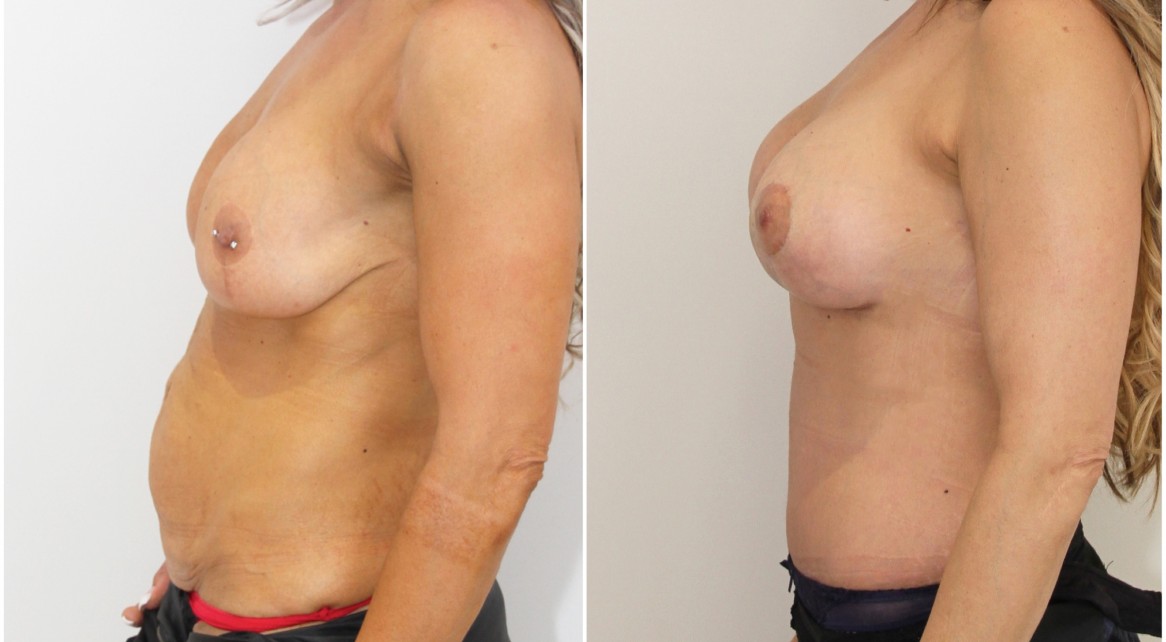 Mummy Makeover featuring removal and replacement/lift of old breast implants and muscle tightening tummy tuck.