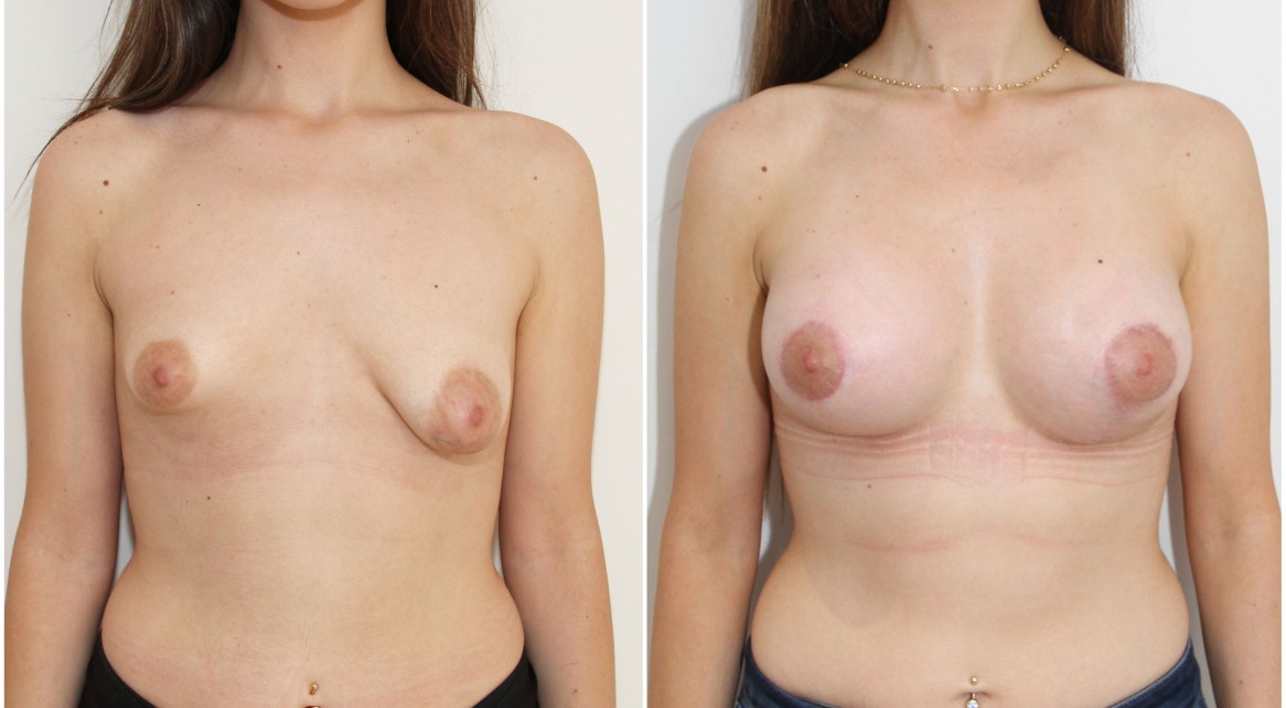 20s, bilateral tuberous breasts, periareolar mastopexy and lift with implants to reshape.