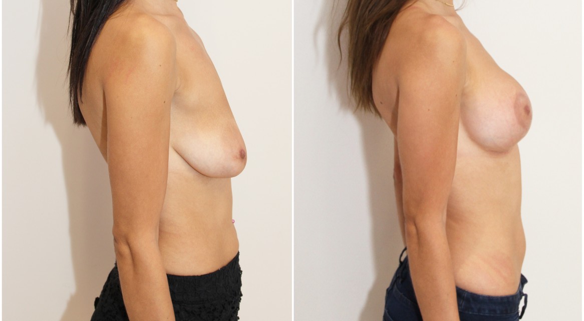 20s, tuberous breasts combined with ptosis (droop), correction with breast lift/reshape and 325g implants.