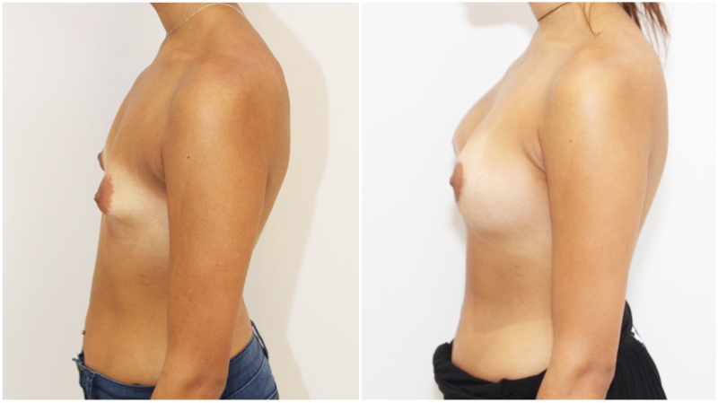 20s, tuberous breast shape corrected with subfascially placed 315g high profile anatomics.