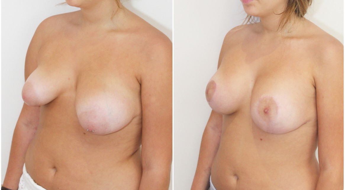 Early 20s, grade 2 tuberous breasts bilaterally, vertical reshape and lift with anatomical 280cc implants.