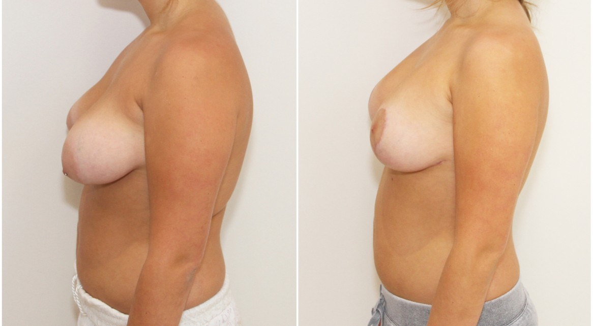 20s, breast lift and implants with 280cc moderate profile anatomics.