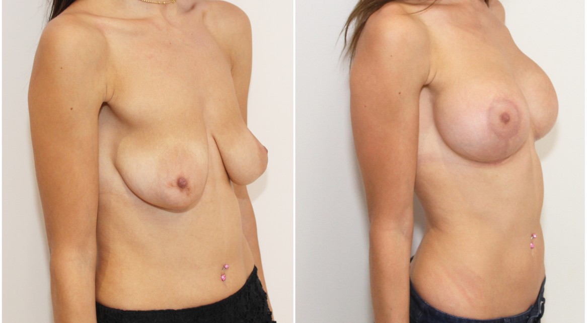 Breast lift + implants with subfascial placed, round style 325g implants.